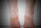 Heal cracked heel