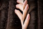 Dandruff Cure