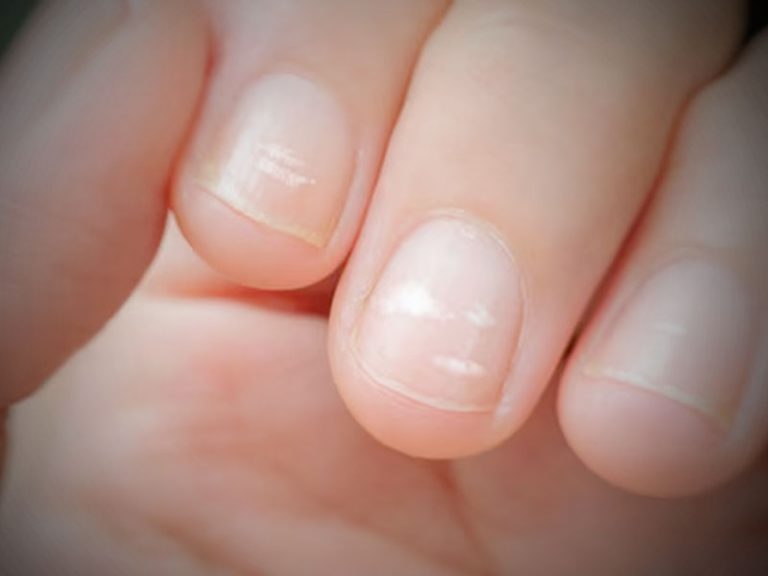 Understanding White Spots on Nails Causes and Remedies for a Flawless Nail