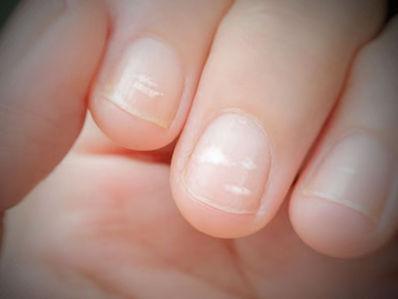 White Spot on Nails