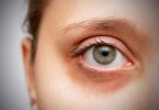 Black Spot Under Eye