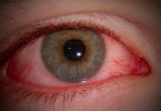 Eye Flu